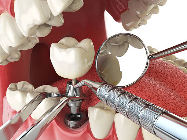 Best Emergency Wisdom Tooth Extraction in Cairo, NE